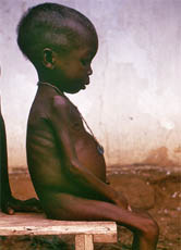 Vor allem in Afrika haben viele Länder mit Hungerproblemen zu kämpfen. Besonders schlimm sind die Folgen von Mangelernährung für Kleinkinder.