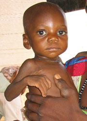 Dieses Baby ist eines von 800.000 Kindern unter fünf Jahren, die laut Unicef hungern müssen.