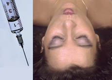Schönheits-OPs und Botox liegen im Trend. Bei einer Botox-Behandlung gegen Falten werden geringe Mengen des gefährlichen Nervengiftes unter die Haut gespritzt.