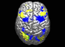 Man geht davon aus, dass bei Autisten Informationen im Gehirn anders verarbeitet werden als bei anderen Menschen. Hier sieht man, dass bei einer Bewegungsaufgabe bei Autisten andere Hirnregionen genutzt werden (gelb markiert) als bei anderen Testpersonen (blau).